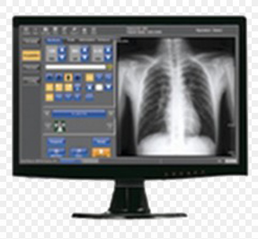 X-ray Digital Data Digital Image Light Radiography, PNG, 1181x1098px, Xray, Computed Radiography, Computer Monitor, Computer Monitor Accessory, Computer Monitors Download Free