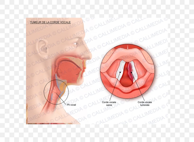 Vocal Folds Cancer Human Anatomy Vowel, PNG, 600x600px, Watercolor, Cartoon, Flower, Frame, Heart Download Free