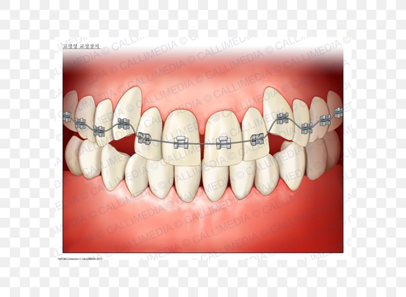 Tooth Dentistry Dental Braces Orthodontics Medicine, PNG, 600x600px, Watercolor, Cartoon, Flower, Frame, Heart Download Free