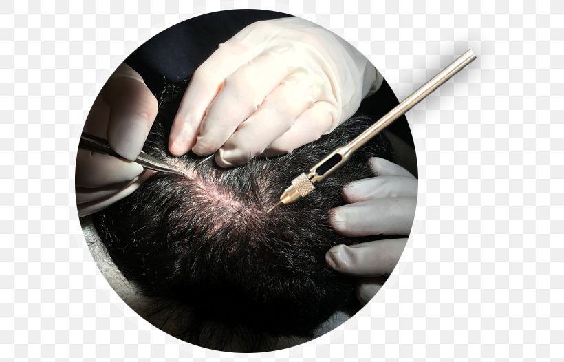 Hair Transplantation Acıbadem Fulya Hospital Acıbadem Healthcare Group Capelli, PNG, 628x526px, Hair Transplantation, Capelli, Finger, Hair, Hair Care Download Free
