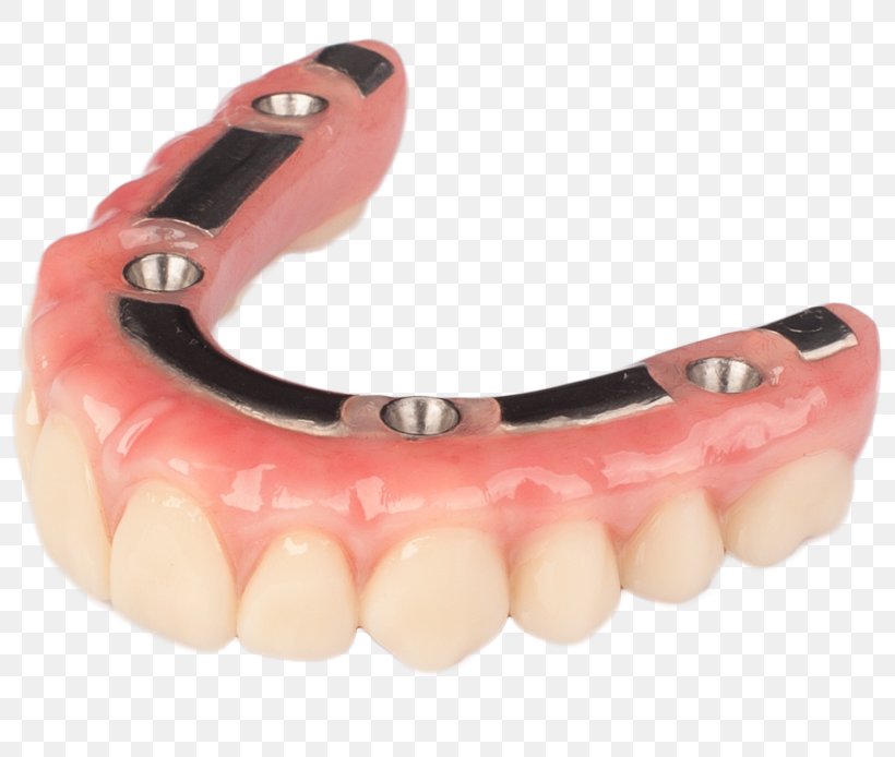 Tooth Dentures Dental Implant Prosthesis, PNG, 800x694px, Tooth, Bridge, Dental Implant, Dental Restoration, Dentistry Download Free