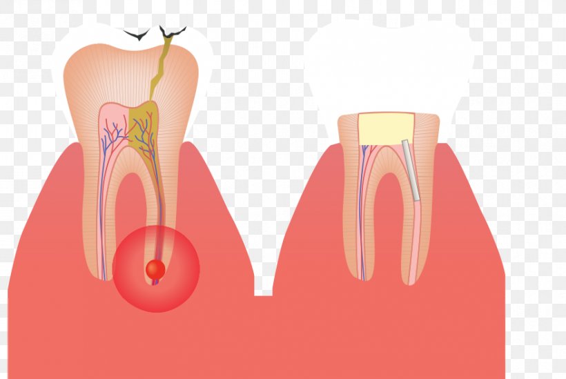 Shoulder Tooth Root Canal Gross Anatomy, PNG, 878x588px, Watercolor, Cartoon, Flower, Frame, Heart Download Free