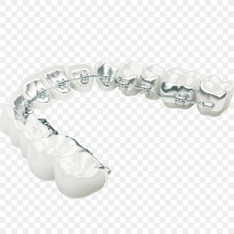 Lingual Braces Orthodontics Dental Braces Clear Aligners Orthodontic Technology, PNG, 1700x1700px, Lingual Braces, Body Jewelry, Bracelet, Clear Aligners, Cosmetic Dentistry Download Free