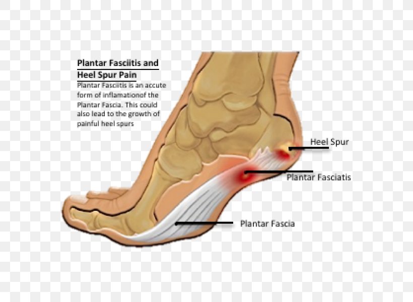 Heel Pain Calcaneal Spur Plantar Fasciitis Foot, PNG, 600x600px, Watercolor, Cartoon, Flower, Frame, Heart Download Free