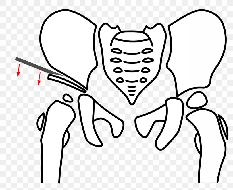 Osteotomy Pelvis Triple-Osteotomie Hip Dysplasia Acetabulum, PNG, 1260x1024px, Watercolor, Cartoon, Flower, Frame, Heart Download Free