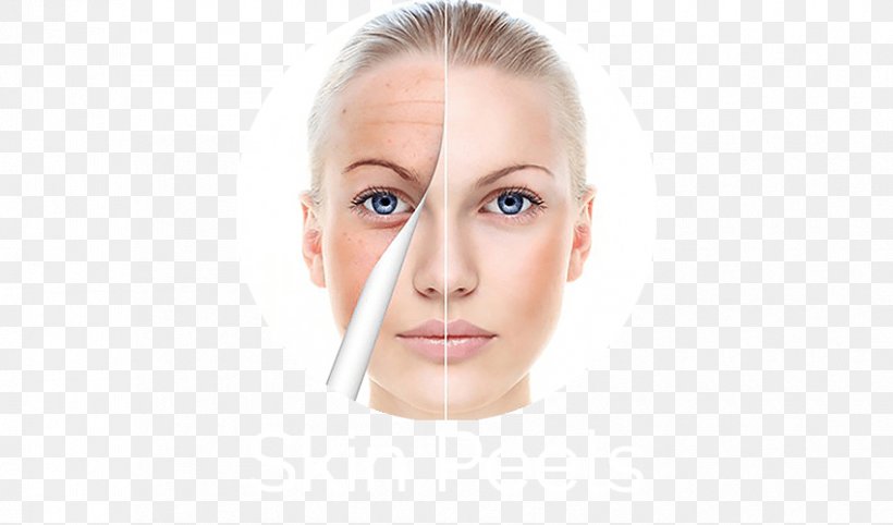 Facial Chemical Peel Wrinkle Face Anti-aging Cream, PNG, 850x500px, Facial, Antiaging Cream, Beauty, Botulinum Toxin, Cheek Download Free