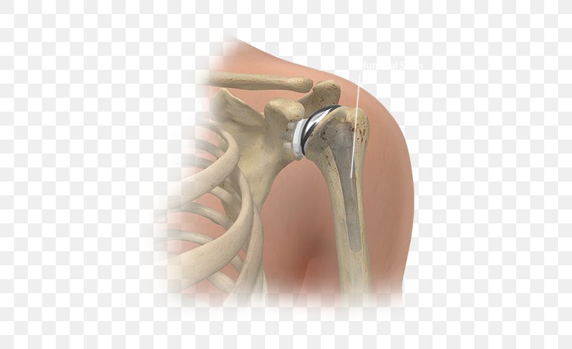 Shoulder Replacement Joint Replacement Surgery Knee Replacement, PNG, 500x500px, Shoulder, Ankle, Arthrodesis, Finger, Hand Download Free