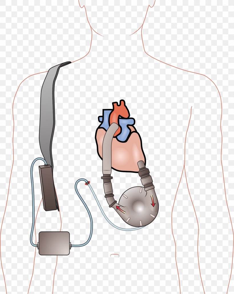 Ventricular Assist Device Artificial Heart Ventricle Heart Failure, PNG, 1366x1714px, Watercolor, Cartoon, Flower, Frame, Heart Download Free