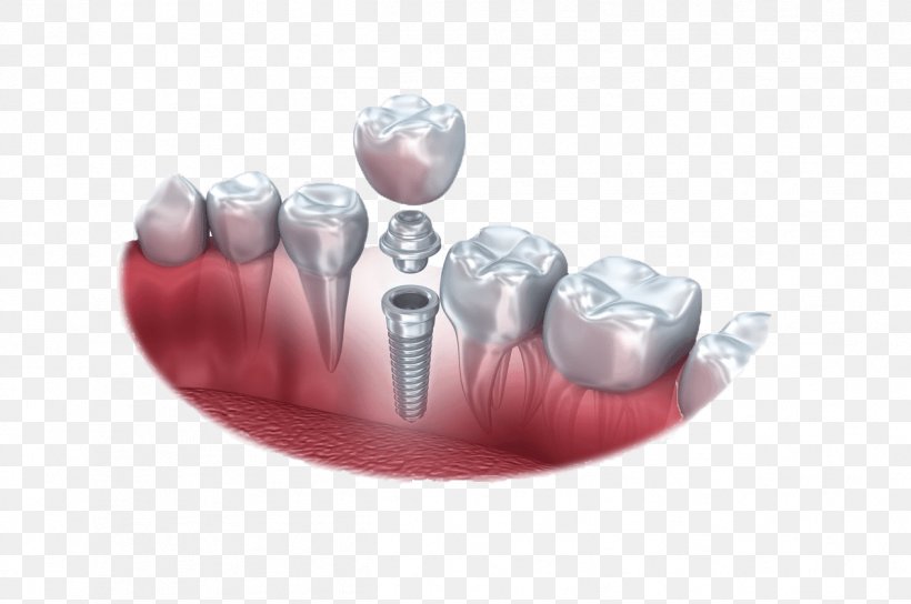 Dental Implant Dentistry Tooth, PNG, 1264x840px, Dental Implant, Bridge, Cosmetic Dentistry, Crown, Dental Surgery Download Free