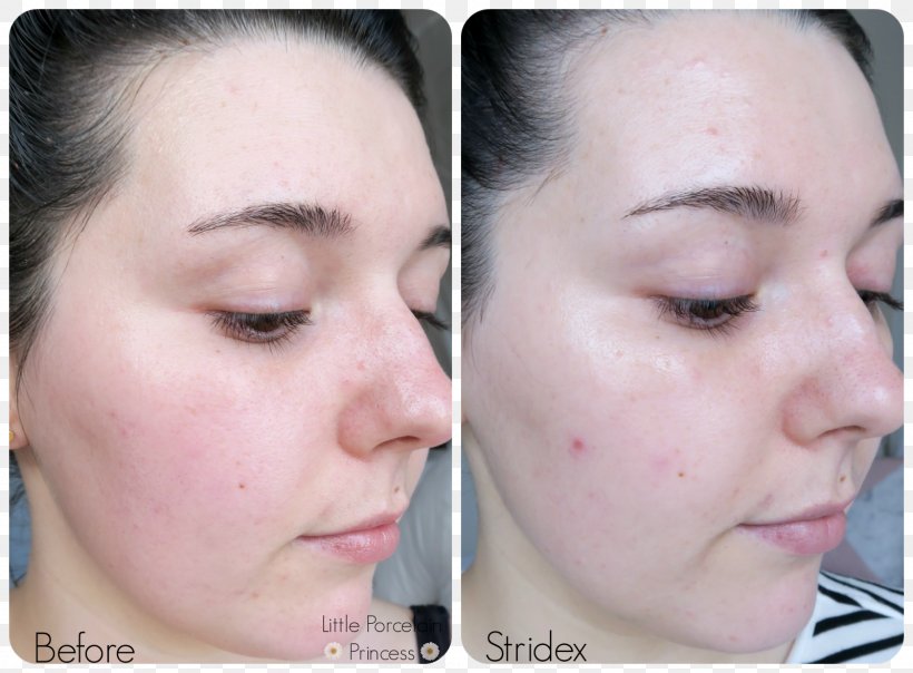 Stridex Maximum Acne Face Skin, PNG, 1600x1180px, Stridex, Acne, Beta Hydroxy Acid, Cheek, Chin Download Free