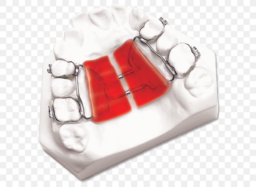 DynaFlex Palatal Expansion Orthodontics Orthodontic Technology Maxilla, PNG, 612x600px, Dynaflex, Home Appliance, Mandible, Maxilla, Orthodontic Technology Download Free