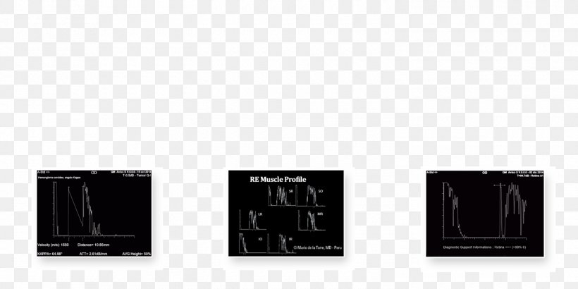 Frequency Ultrasonography Ultrasound Anterior Chamber Of Eyeball Hertz, PNG, 1500x750px, Frequency, Anterior Chamber Of Eyeball, Anterior Segment Of Eyeball, Aviso, Biostatistics Download Free