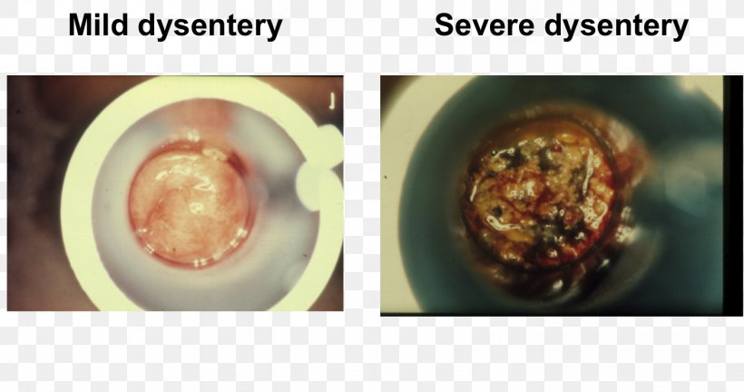 Human Feces Dysentery Diarrhea Blood In Stool Stool Test, PNG, 1409x744px, Human Feces, Amoebiasis, Bleeding, Blood, Blood In Stool Download Free