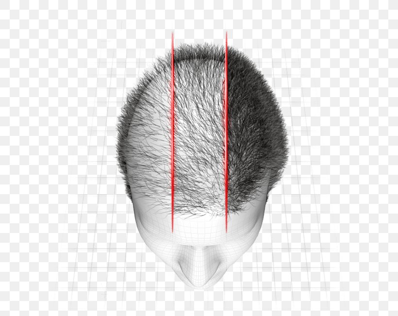 Hair Loss Botak Tónico Marco Antônio Vale Gomes, PNG, 624x651px, Hair Loss, Beta Blocker, Botak, Brazil, Brush Download Free