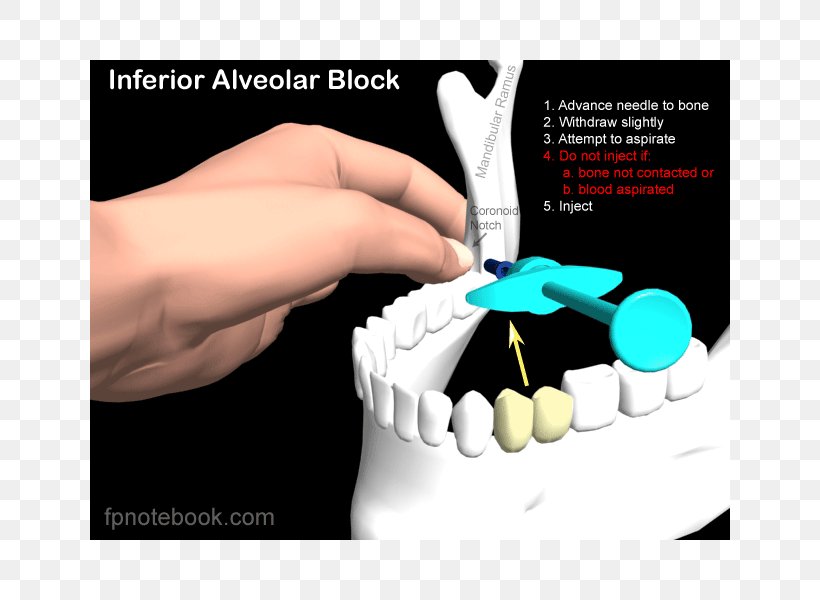 Inferior Alveolar Nerve Anaesthesia Posterior Superior Alveolar Nerve Mandibular Nerve Nerve Block, PNG, 800x600px, Inferior Alveolar Nerve, Advertising, Anterior Superior Alveolar Nerve, Dentistry, Finger Download Free