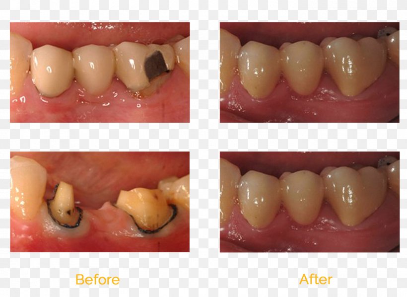 Tooth Bridge Molar Dentistry Dental Implant, PNG, 1400x1021px, Tooth, Bridge, Cosmetic Dentistry, Crown, Dental Implant Download Free