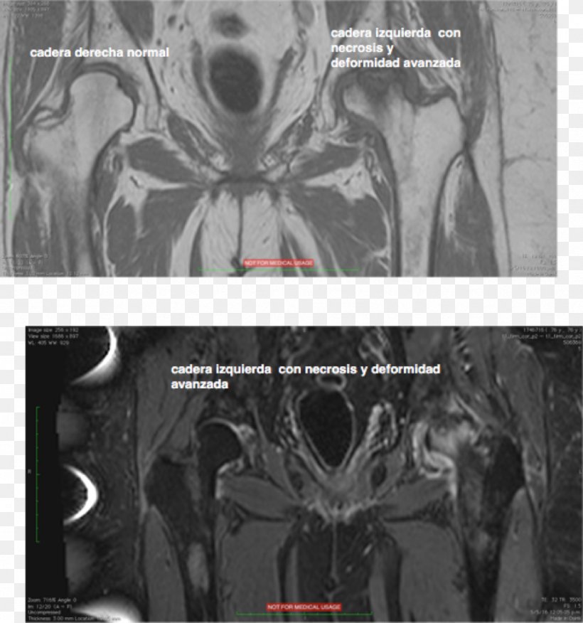 Bone Infarction Computed Tomography Femoral Head Femur Legg–Calvé–Perthes Disease, PNG, 921x985px, Computed Tomography, Base, Black And White, Bone, Femoral Head Download Free