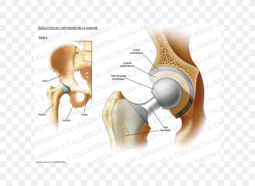 Hip Osteoarthritis Prosthesis Rheumatoid Arthritis, PNG, 600x600px, Watercolor, Cartoon, Flower, Frame, Heart Download Free