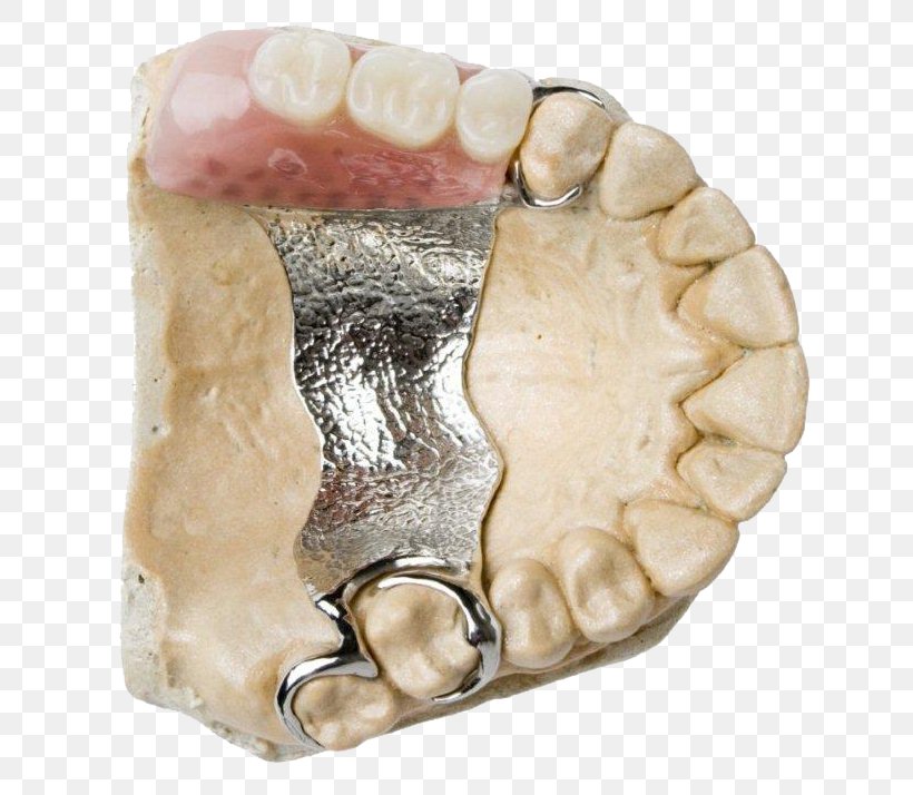 Dental Prosthesis Dentistry Dentures Prosthodontics, PNG, 661x714px, Dental Prosthesis, Cosmetic Dentistry, Dental Implant, Dental Surgery, Dentistry Download Free