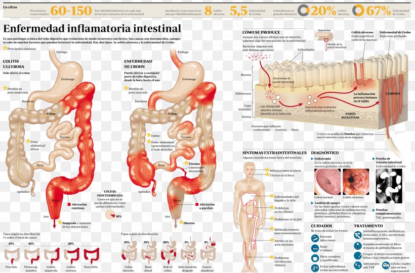 Inflammatory Bowel Disease Crohn's Disease Ulcerative Colitis Intestine, PNG, 3000x1981px, Watercolor, Cartoon, Flower, Frame, Heart Download Free