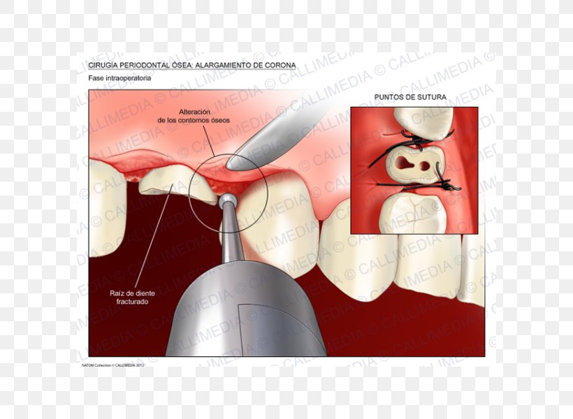 Crown Lengthening Surgery Periodontal Disease Tooth, PNG, 600x600px, Crown Lengthening, Bone, Crown, Dental Abscess, Dentist Download Free