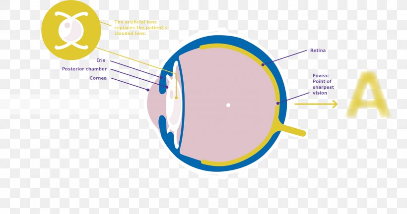 Cataract Surgery Intraocular Lens Merck Group, PNG, 1596x842px, Cataract Surgery, Area, Brand, Cataract, Darmstadt Download Free