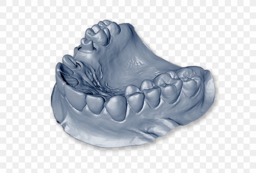 Dentistry Dental Implant Dental Laboratory Dentures, PNG, 1280x866px, Dentistry, Cosmetic Dentistry, Crown, Dental Implant, Dental Laboratory Download Free