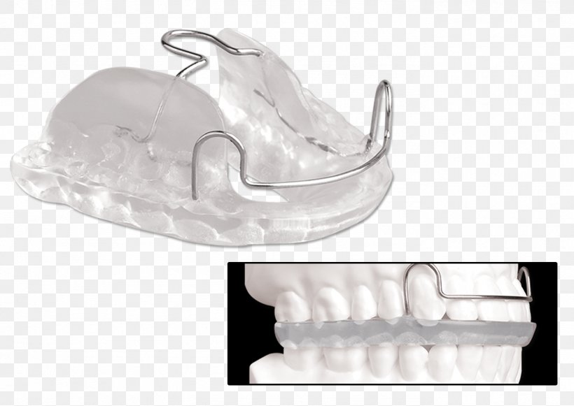 Jaw Mandible Splint Dentistry Maxilla, PNG, 1388x984px, Jaw, Bionator, Dentistry, Dynaflex, Hand Download Free
