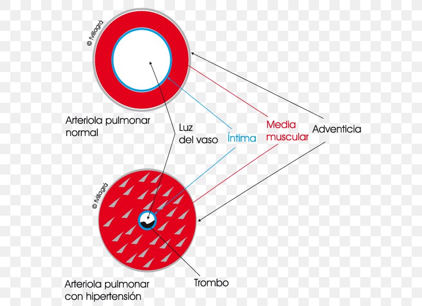 Lung Pulmonary Artery Pulmonary Hypertension Pulmonary Shunt, PNG, 595x596px, Lung, Area, Artery, Brand, Circulatory System Download Free