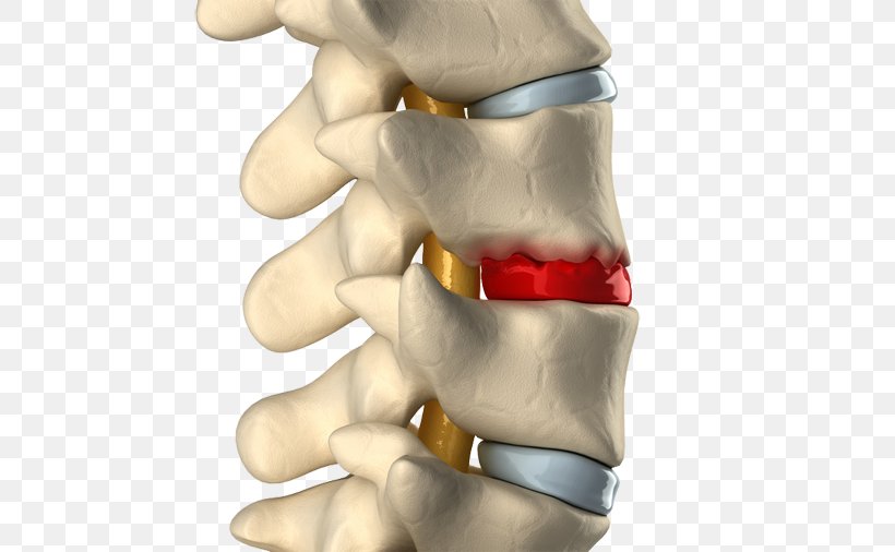 Spinal Disc Herniation Degenerative Disc Disease Intervertebral Disc Vertebral Column Osteophyte, PNG, 506x506px, Watercolor, Cartoon, Flower, Frame, Heart Download Free