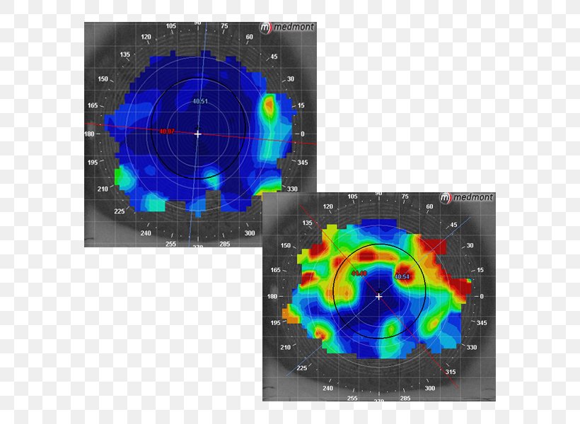 Dry Eye Syndrome Corneal Topography Eye Examination Optometry, PNG, 600x600px, Dry Eye Syndrome, Blurred Vision, Cornea, Corneal Topography, Disease Download Free