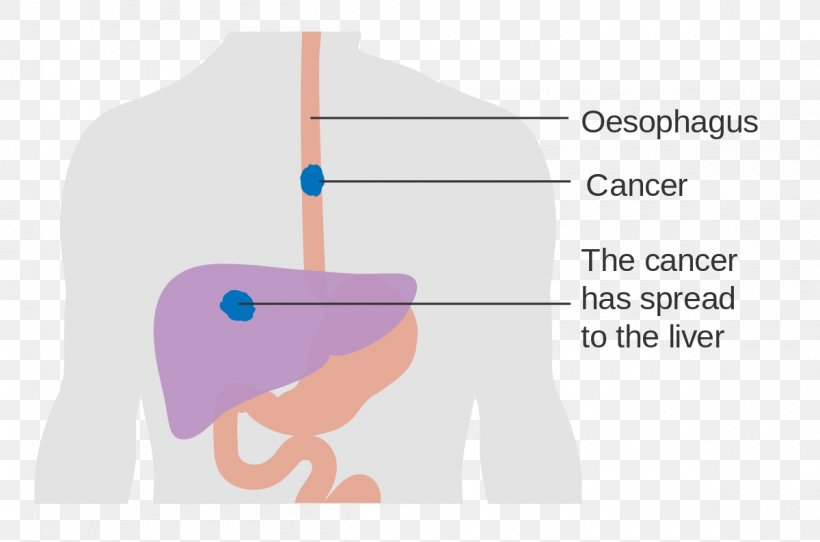 Esophageal Cancer Esophagus Dysphagia Disease, PNG, 1200x794px, Watercolor, Cartoon, Flower, Frame, Heart Download Free