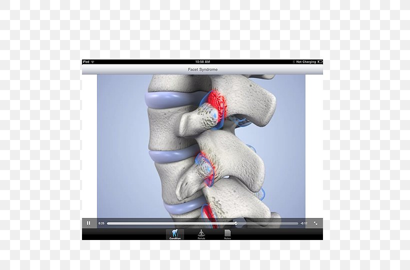 Facet Joint Injection Facet Syndrome Pain, PNG, 610x540px, Facet Joint, Cervical Vertebrae, Chiropractic, Facet Joint Injection, Facet Syndrome Download Free