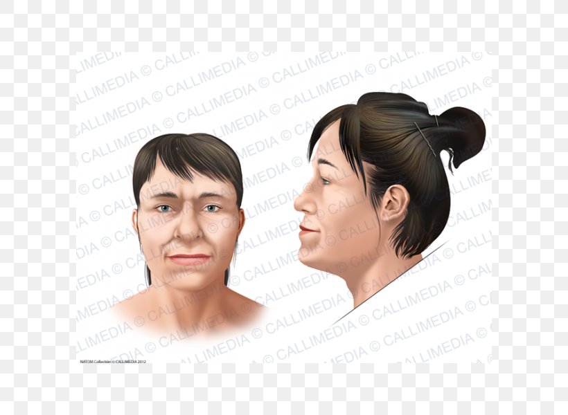 Acromegaly Face Symptom Skull Bossing Gigantism, PNG, 600x600px, Acromegaly, Cheek, Chin, Clinic, Ear Download Free