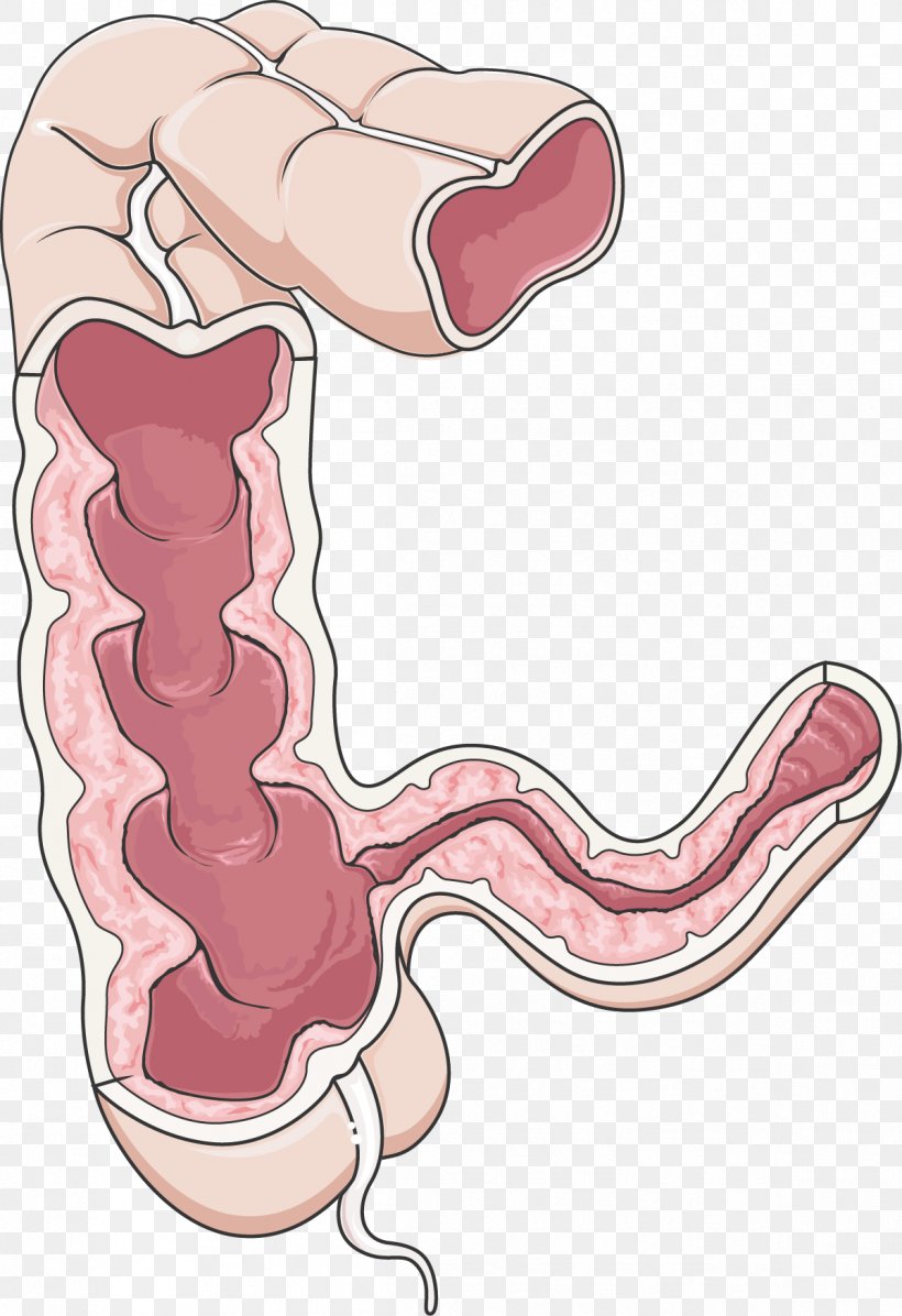 Crohn's Disease Large Intestine Gastrointestinal Tract Inflammatory