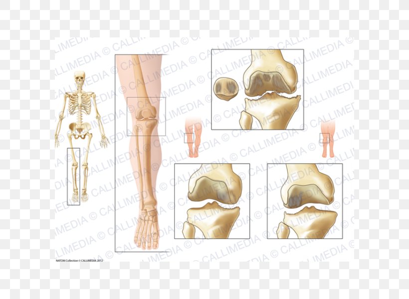 La Gonarthrose Knee Osteoarthritis Knee Osteoarthritis Knee Arthritis, PNG, 600x600px, Osteoarthritis, Abdomen, Arm, Arthritis, Bone Download Free