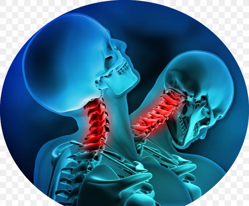 Whiplash Auto Injury Specialists Of Florida Neck Pain Chiropractic, PNG, 875x725px, Whiplash, Accident, Chiropractic, Head, Injury Download Free