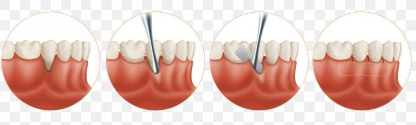 Gingival Graft Gums Soft Tissue Gingival Recession, PNG, 1063x319px, Graft, Dentistry, Disease, Finger, Gingival Graft Download Free