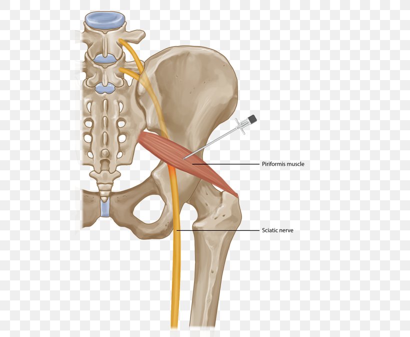 Piriformis Syndrome Piriformis Muscle Injection Surgery Sciatica, PNG, 520x673px, Watercolor, Cartoon, Flower, Frame, Heart Download Free