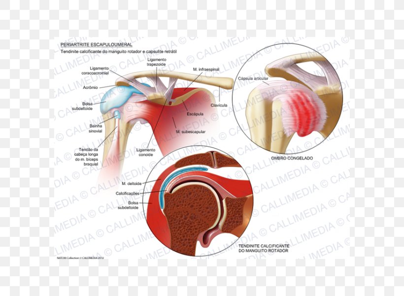 Adhesive Capsulitis Of Shoulder Arthritis Periartrite Scapolo-omerale Rheumatology Ache, PNG, 600x600px, Watercolor, Cartoon, Flower, Frame, Heart Download Free
