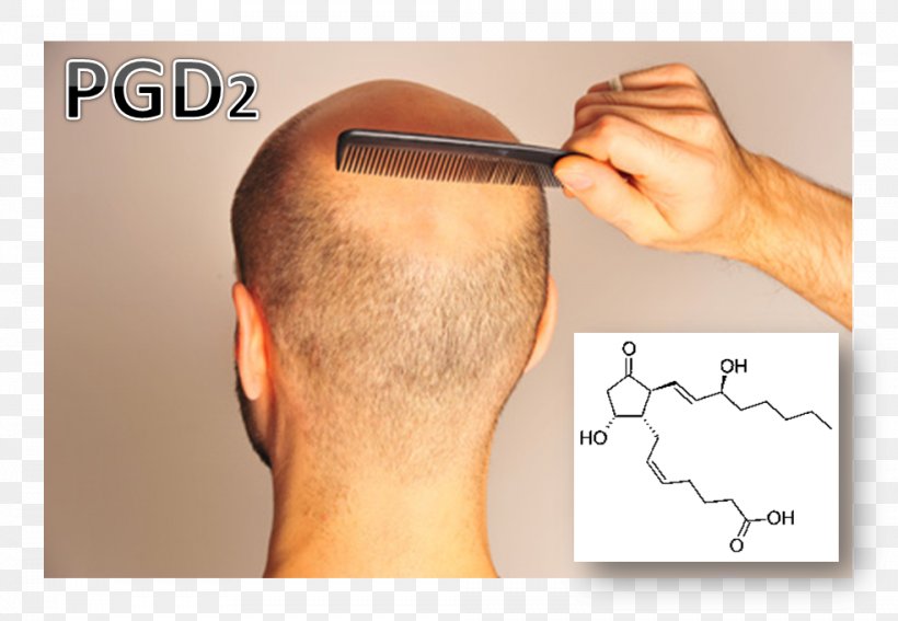 Hair Loss Prostaglandin D2 Scalp, PNG, 984x681px, Watercolor, Cartoon, Flower, Frame, Heart Download Free