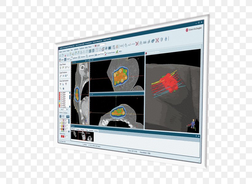 Eckert & Ziegler Display Device Brachytherapy Multimedia Radiation Treatment Planning, PNG, 728x600px, Display Device, Advertising, Brachytherapy, Display Advertising, Electronic Visual Display Download Free