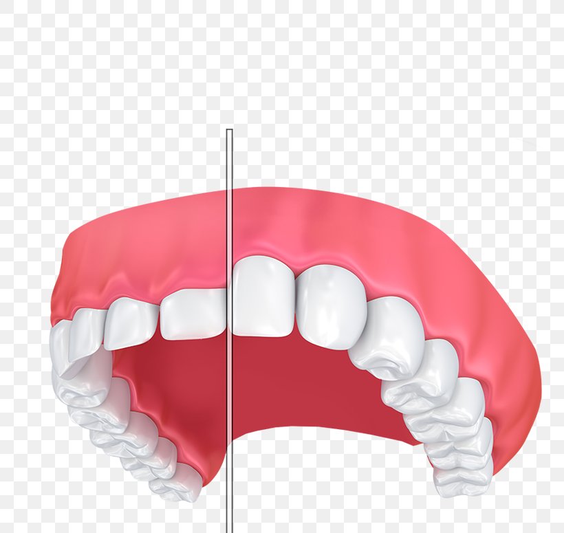 Gums Gum Lift Dentistry Tooth Gummy Smile, PNG, 800x775px, Gums, Contouring, Cosmetic Dentistry, Crown, Dentistry Download Free