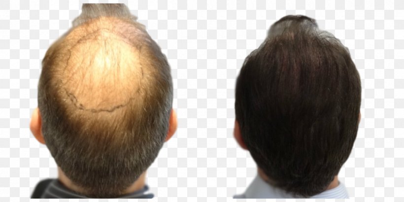 Hair Transplantation Follicular Unit Extraction Step Cutting Long Hair, PNG, 1200x600px, Hair Transplantation, Brown Hair, Follicular Unit Extraction, Hair, Hair Coloring Download Free