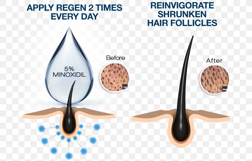 Minoxidil Management Of Hair Loss Hair Follicle Human Hair Growth, PNG, 706x525px, Minoxidil, Afrotextured Hair, Hair, Hair Care, Hair Coloring Download Free