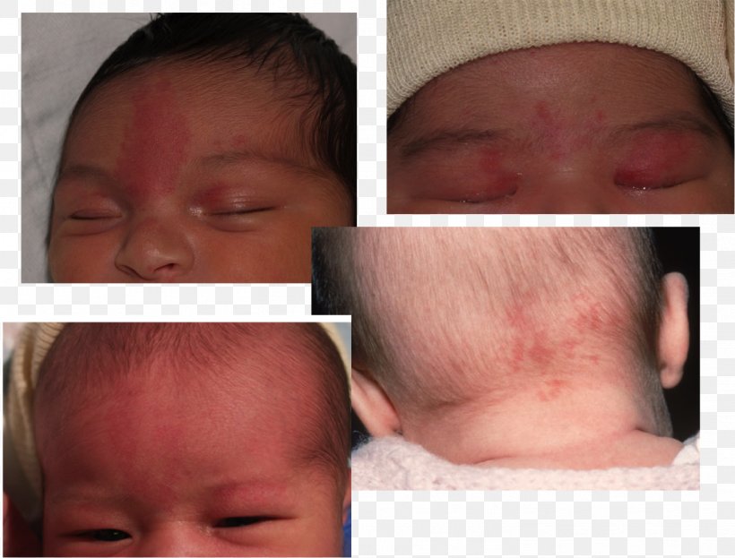 Nevus Flammeus Nuchae Infant Birthmark Nevus Sebaceous Sebaceous Gland, PNG, 1456x1107px, Nevus Flammeus Nuchae, Birthmark, Cheek, Child, Chin Download Free