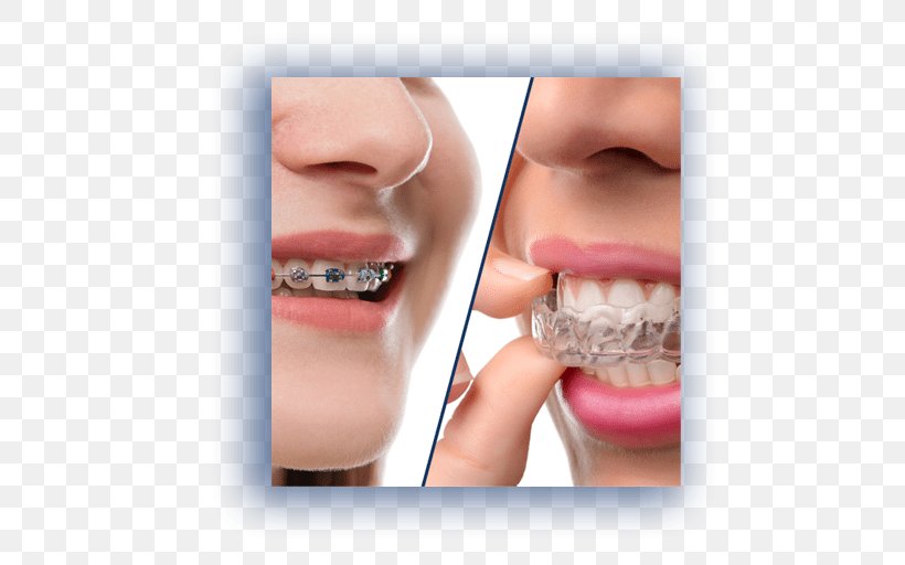 Clear Aligners Orthodontics Dental Braces Dentistry, PNG, 512x512px, Clear Aligners, Cheek, Chin, Close Up, Cosmetic Dentistry Download Free