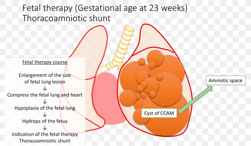 Congenital Pulmonary Airway Malformation Shunt Fetus Lung Cyst, PNG, 800x477px, Watercolor, Cartoon, Flower, Frame, Heart Download Free