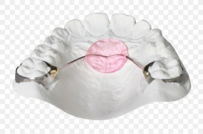 Orthodontics Orthodontic Technology Bionator Jaw Retainer, PNG, 1024x676px, Orthodontics, Bionator, Cots, David Gergen, Home Appliance Download Free