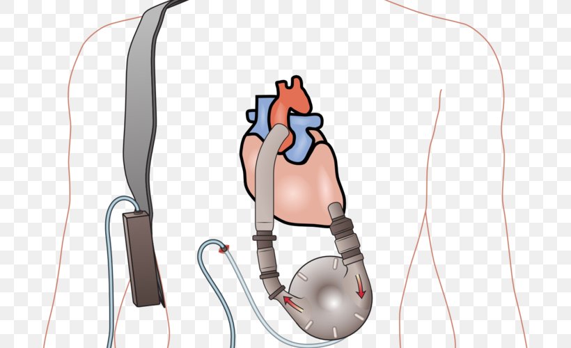 Ventricular Assist Device Heart Transplantation Ventricle Heart Failure, PNG, 700x500px, Watercolor, Cartoon, Flower, Frame, Heart Download Free